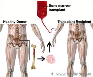 Bone marrow stem cells transplant