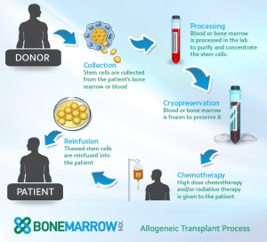 Allogenic stem cell transplant