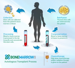 Autologous stem cell transplant